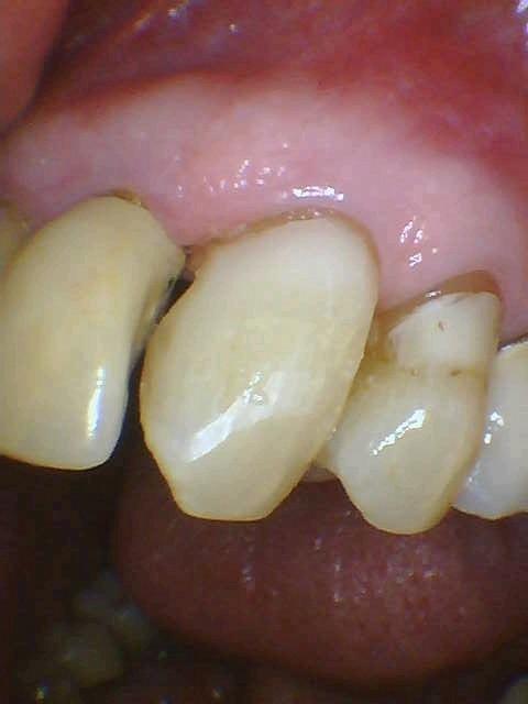 Bonded-Composite-Restoration-After-Image