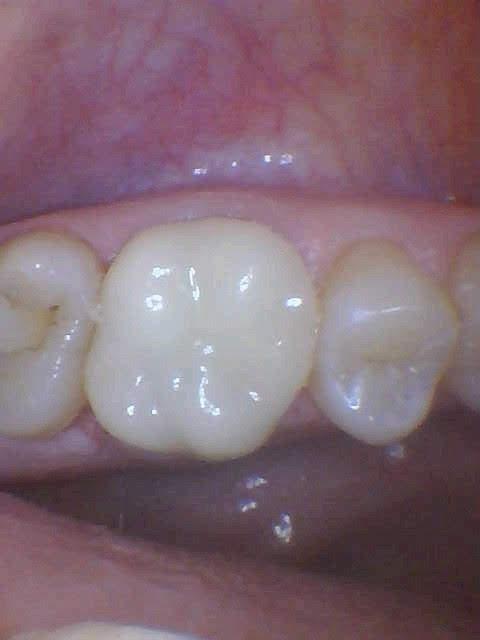 Same-day-crown-After-Image