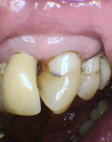 Bonded-Composite-Restoration-Before-Image