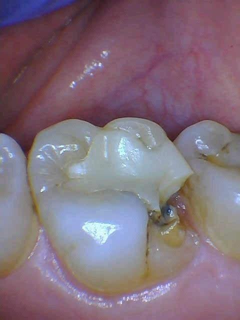 Same-day-crown-Before-Image